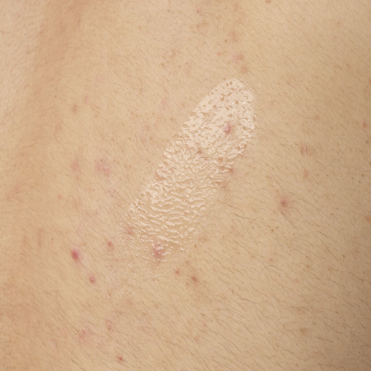 salicylic-acid-0-5-body-serum-f3 ORD-salicylic-acid-05-body-240ml-application.jpg