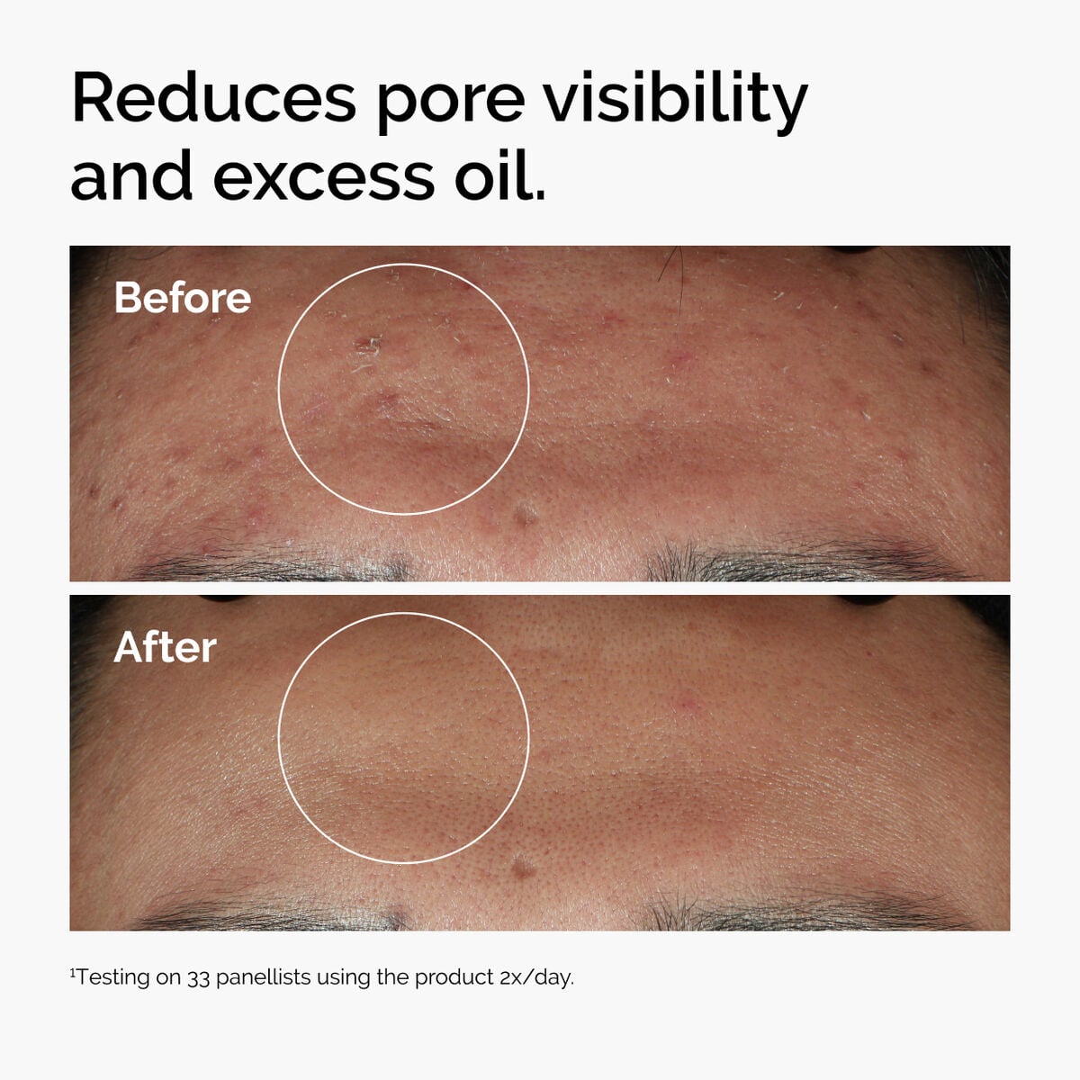 niacinamide-10-zinc-1-y9 ord-niacinamide-zinc-blemish-serum-before-after-pores.jpg