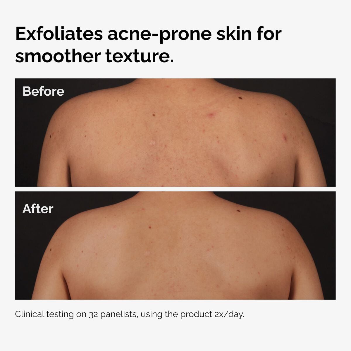 salicylic-acid-0-5-body-serum-f3 ord-salicylic-acid-body-serum-before-after-graphic-NA.jpg
