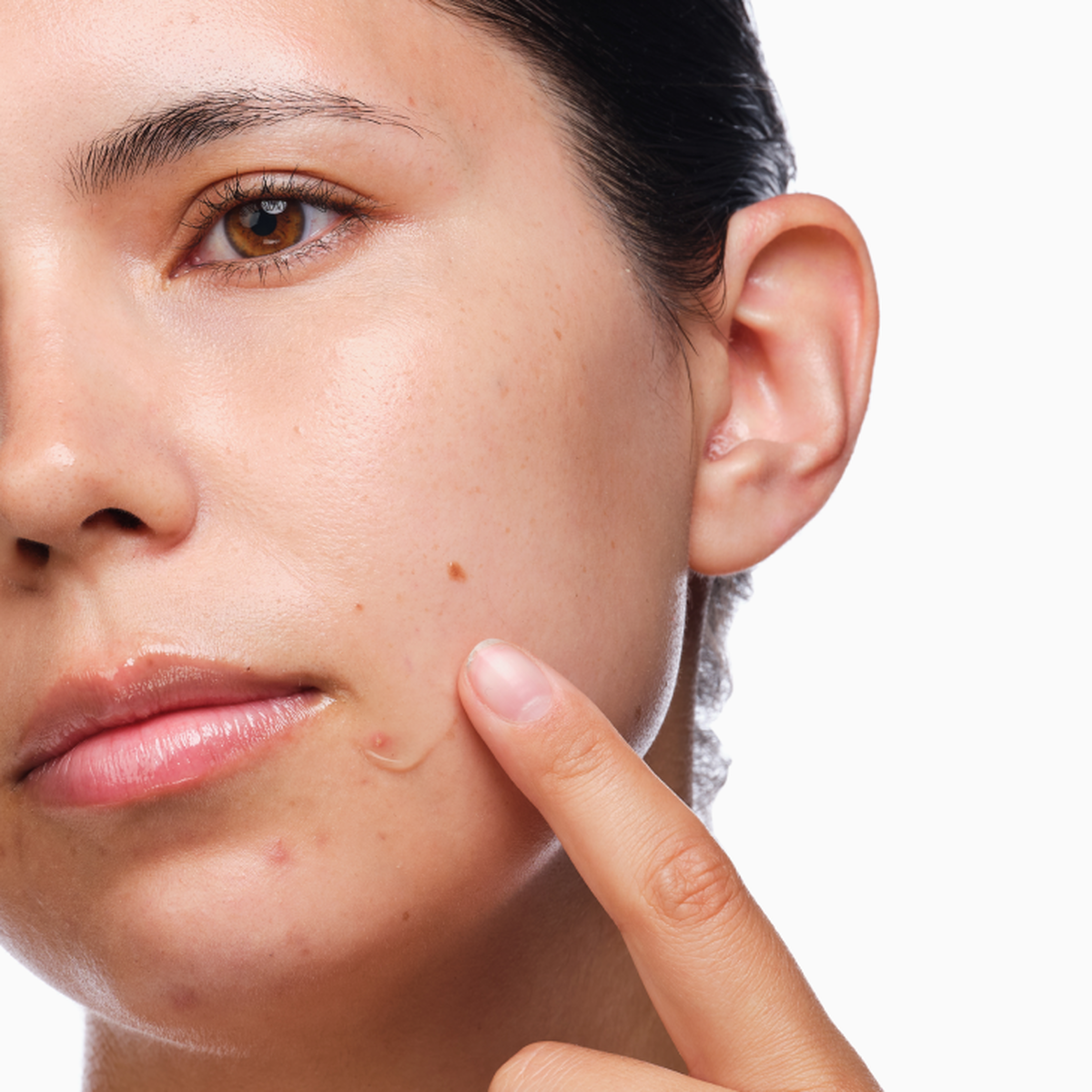 the-acne-set-y9 rdn-the-acne-set-application.png